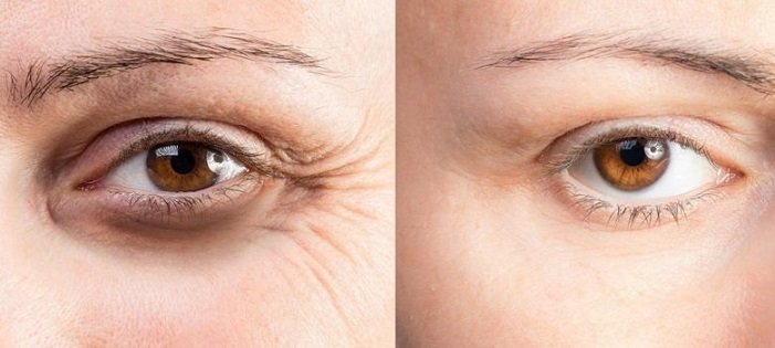 botox before and after crows feet
