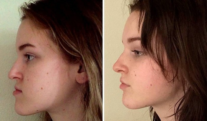 jaw surgery before and after