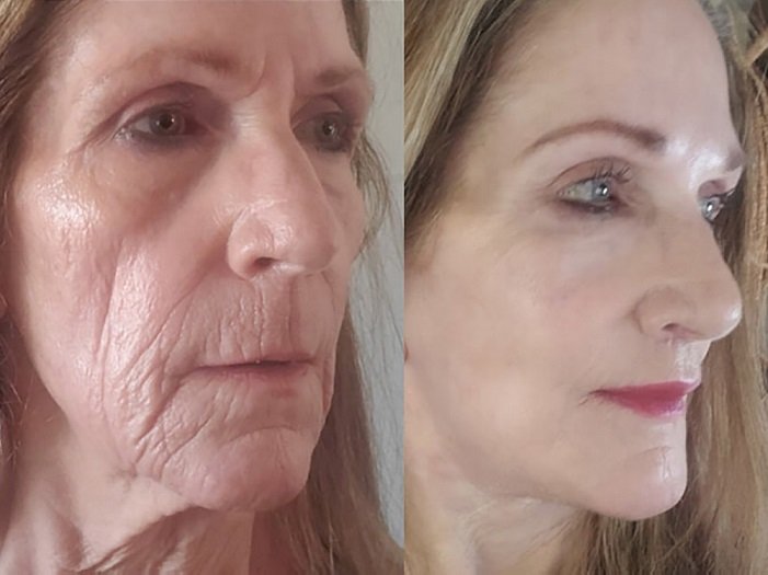 mini facelift before and after